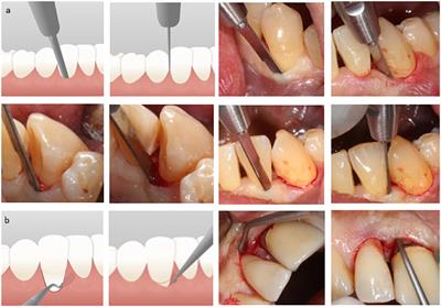 A pioneer surgical technique for isolated periodontal defects by “closed” retraction of the papilla: A feasibility study